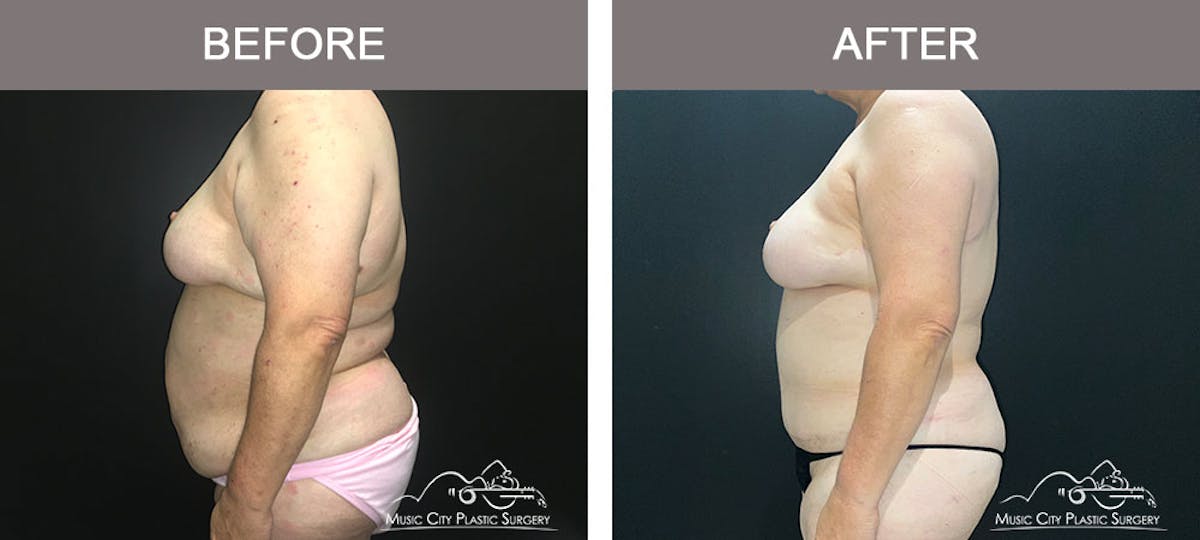 Abdominoplasty Before & After Gallery - Patient 221978 - Image 3