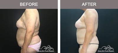 Abdominoplasty Before & After Gallery - Patient 183233240 - Image 3
