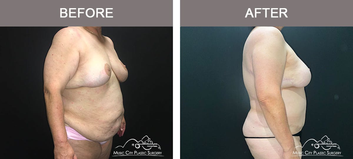 Arm Lift Before & After Gallery - Patient 183233229 - Image 4