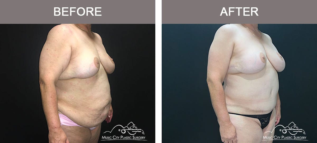Abdominoplasty Before & After Gallery - Patient 221978 - Image 5