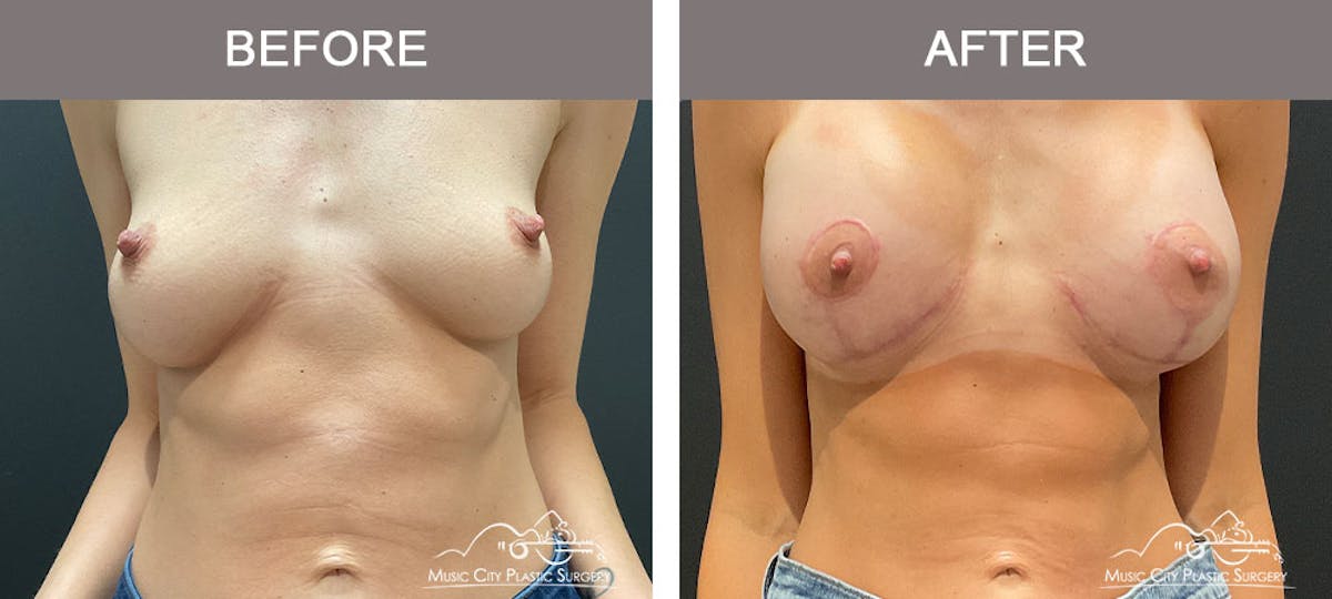 Breast Augmentation Before & After Gallery - Patient 183233342 - Image 1