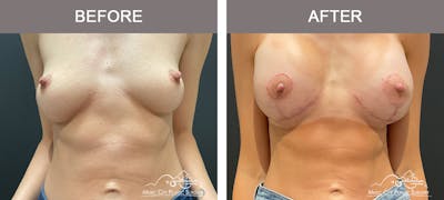 Breast Augmentation Before & After Gallery - Patient 183233342 - Image 1