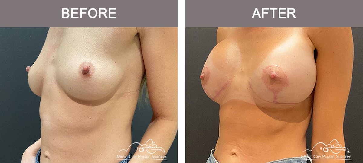Breast Augmentation Before & After Gallery - Patient 183233342 - Image 2