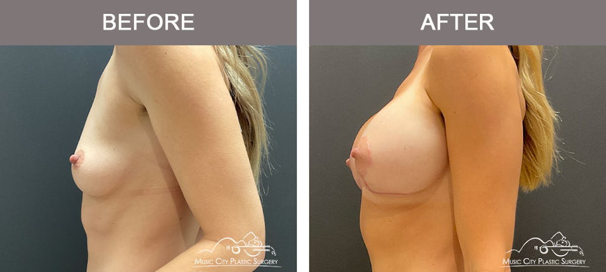 Breast Augmentation Before & After Gallery - Patient 183233342 - Image 3