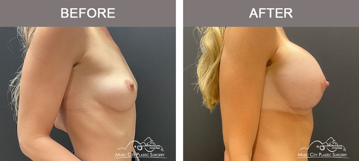 Breast Augmentation Before & After Gallery - Patient 183233342 - Image 4