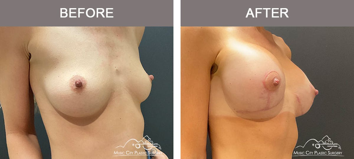 Breast Augmentation Before & After Gallery - Patient 183233342 - Image 5