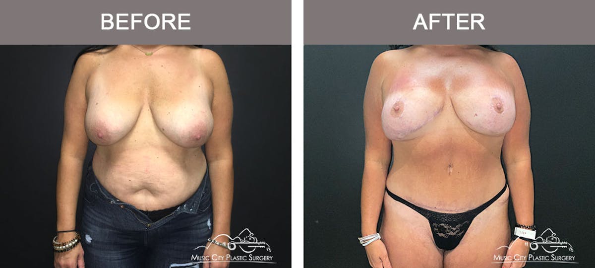 Abdominoplasty Before & After Gallery - Patient 183233367 - Image 1