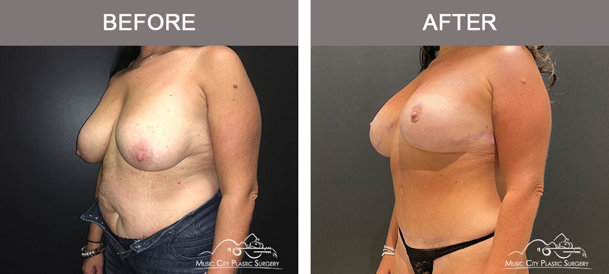 Abdominoplasty Before & After Gallery - Patient 183233367 - Image 2