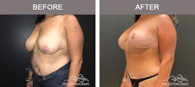 Breast Augmentation Before & After Gallery - Patient 183233362 - Image 2