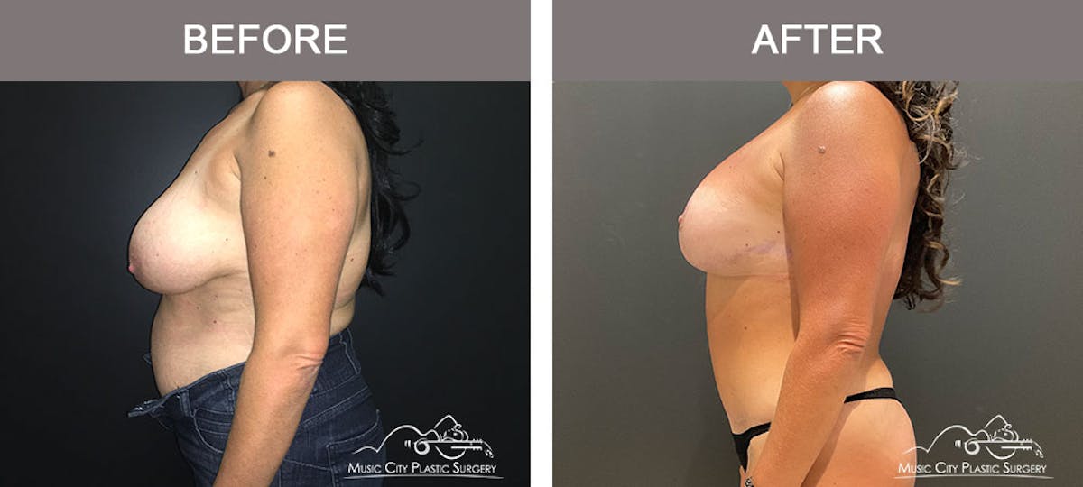 Breast Augmentation Before & After Gallery - Patient 183233362 - Image 3
