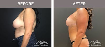 Breast Lift Before & After Gallery - Patient 183233363 - Image 3