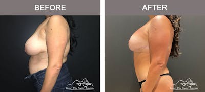 Liposuction Before & After Gallery - Patient 183233368 - Image 3