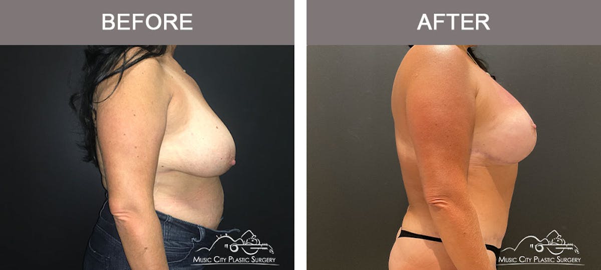 Breast Augmentation Before & After Gallery - Patient 183233362 - Image 4