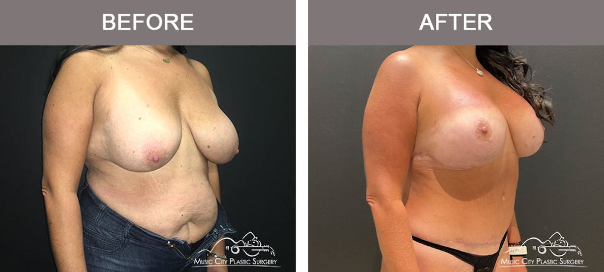 Breast Augmentation Before & After Gallery - Patient 183233362 - Image 5