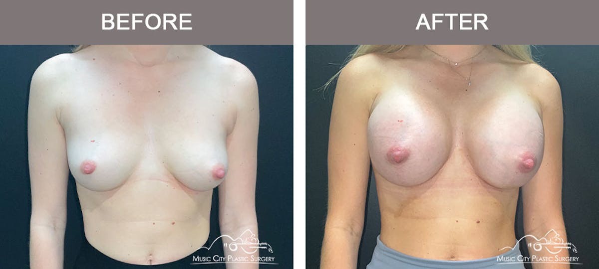 Breast Augmentation Before & After Gallery - Patient 183233373 - Image 1