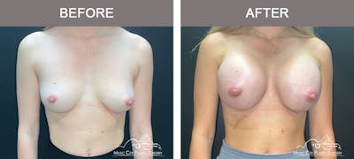 Breast Augmentation Before & After Gallery - Patient 183233373 - Image 1