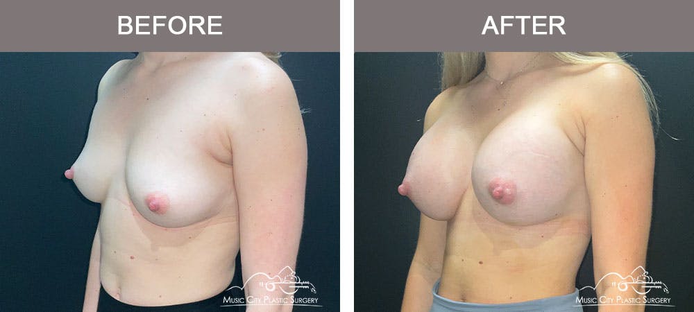 Breast Augmentation Before & After Gallery - Patient 183233373 - Image 2