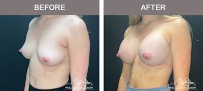 Breast Augmentation Before & After Gallery - Patient 183233373 - Image 2