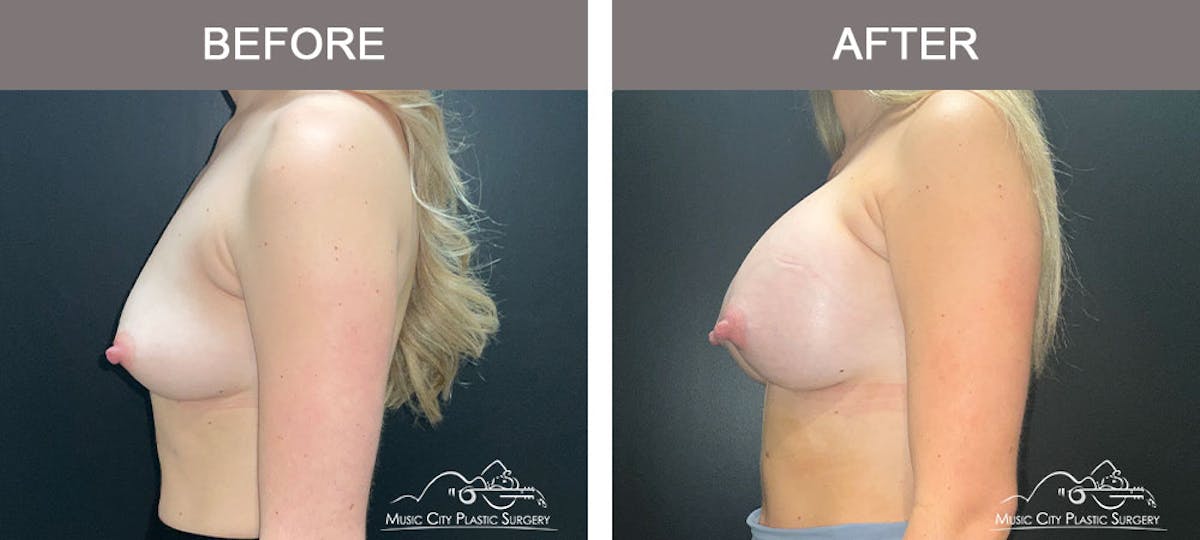 Breast Augmentation Before & After Gallery - Patient 183233373 - Image 3