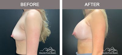 Breast Augmentation Before & After Gallery - Patient 183233373 - Image 3