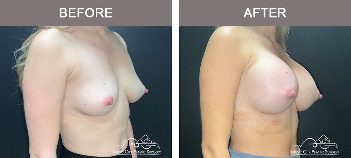 Breast Augmentation Before & After Gallery - Patient 183233373 - Image 4