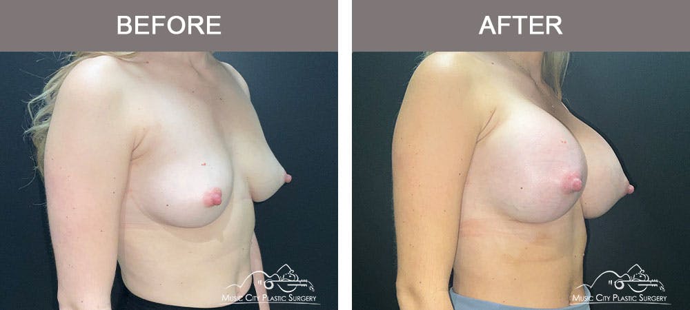 Breast Augmentation Before & After Gallery - Patient 183233373 - Image 4