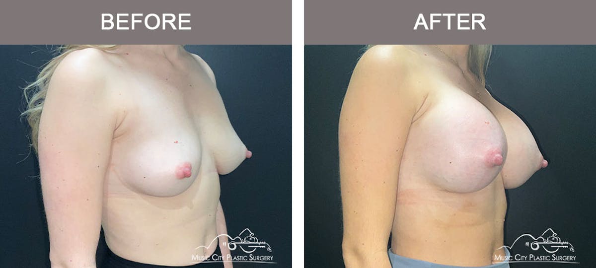 Breast Augmentation Before & After Gallery - Patient 183233373 - Image 4