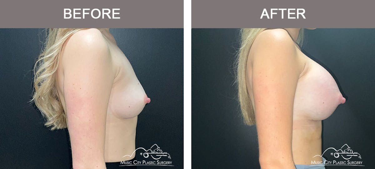 Breast Augmentation Before & After Gallery - Patient 183233373 - Image 5