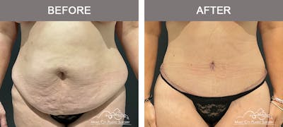 Liposuction Before & After Gallery - Patient 195592416 - Image 1