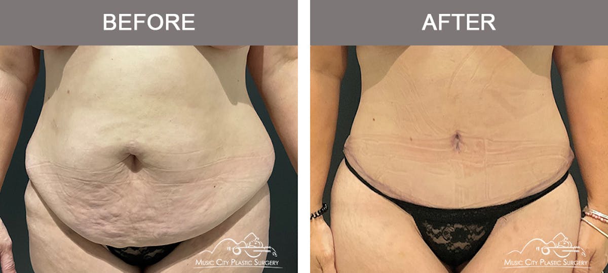 Liposuction Before & After Gallery - Patient 195592416 - Image 1