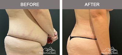 Abdominoplasty Before & After Gallery - Patient 195592414 - Image 3