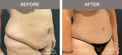 Abdominoplasty Before & After Gallery - Patient 195592414 - Image 2