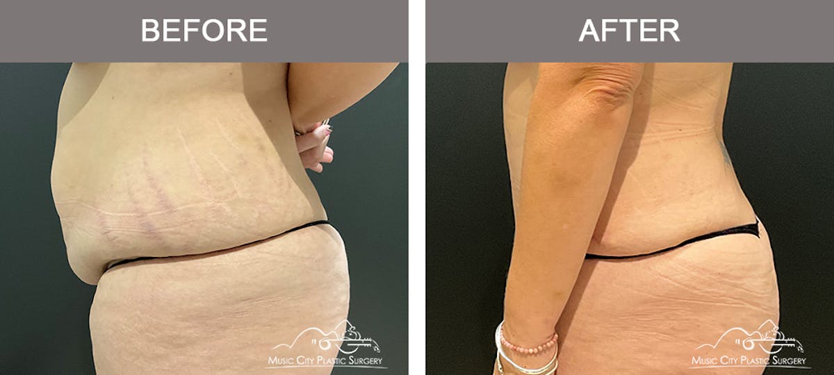 Liposuction Before & After Gallery - Patient 195592416 - Image 4