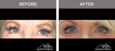 Blepharoplasty Before & After Gallery - Patient 195592417 - Image 1