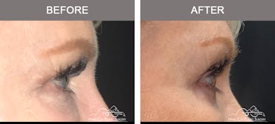 Blepharoplasty Before & After Gallery - Patient 195592417 - Image 2