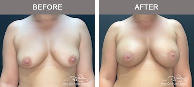 Breast Augmentation Before & After Gallery - Patient 195592419 - Image 1