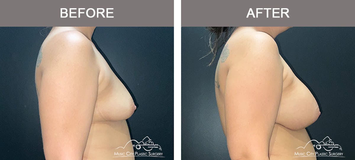 Breast Augmentation Before & After Gallery - Patient 195592419 - Image 3