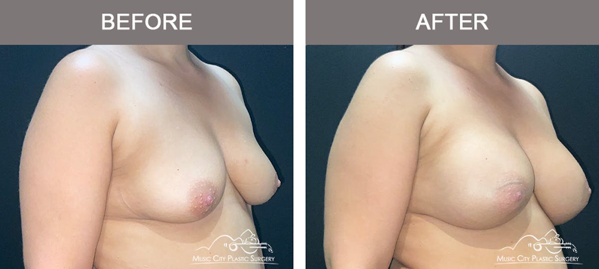 Breast Augmentation Before & After Gallery - Patient 195592419 - Image 2