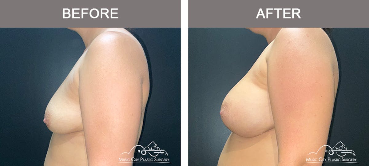 Breast Augmentation Before & After Gallery - Patient 195592419 - Image 5