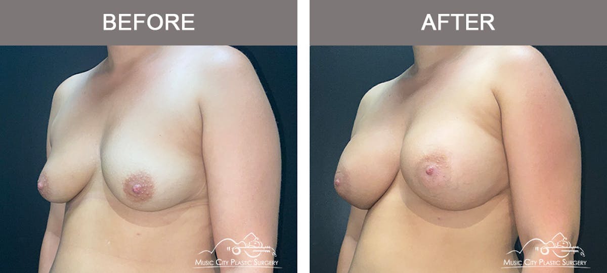 Breast Augmentation Before & After Gallery - Patient 195592419 - Image 4