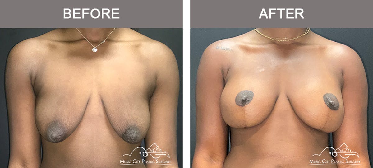 Breast Augmentation Before & After Gallery - Patient 195592420 - Image 1
