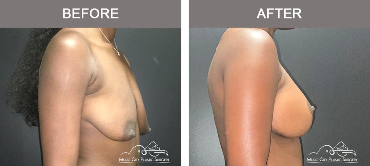 Breast Augmentation Before & After Gallery - Patient 195592420 - Image 3