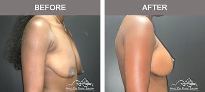 Breast Augmentation Before & After Gallery - Patient 195592420 - Image 3