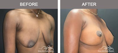 Breast Augmentation Before & After Gallery - Patient 195592420 - Image 2