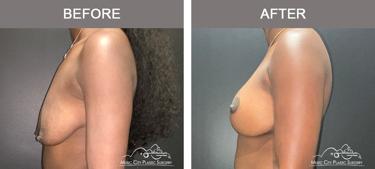 Breast Augmentation Before & After Gallery - Patient 195592420 - Image 5