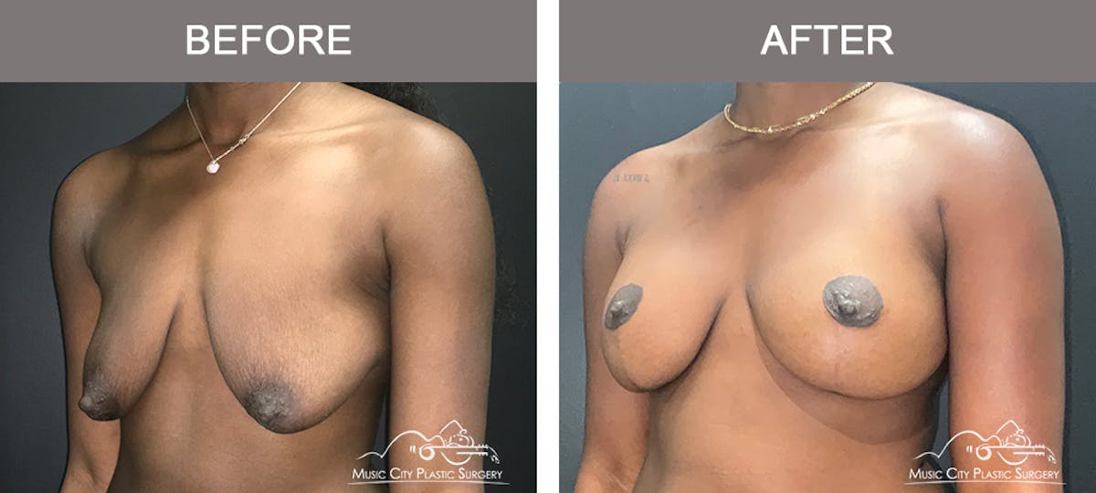 Breast Augmentation Before & After Gallery - Patient 195592420 - Image 4