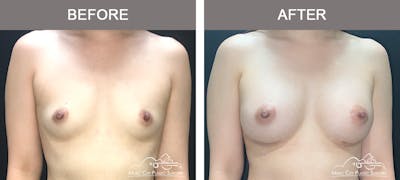 Breast Augmentation Before & After Gallery - Patient 195592422 - Image 1