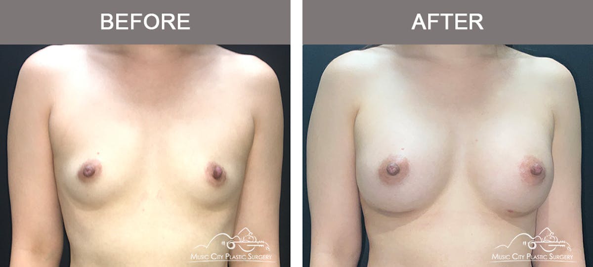 Breast Augmentation Before & After Gallery - Patient 195592422 - Image 1