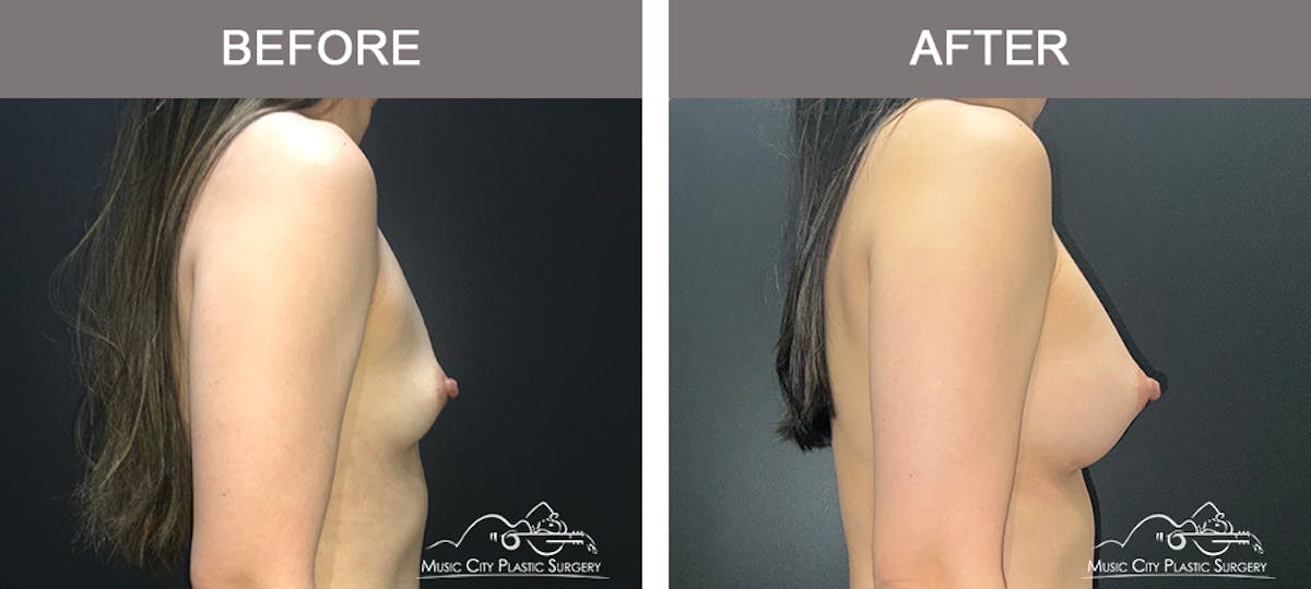 Breast Augmentation Before & After Gallery - Patient 195592422 - Image 3