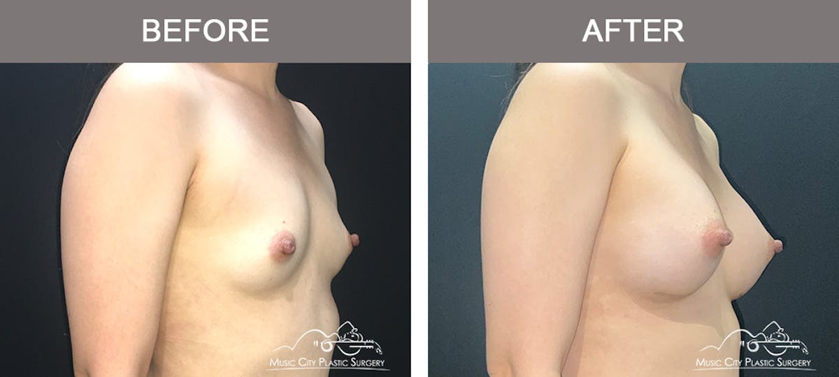 Breast Augmentation Before & After Gallery - Patient 195592422 - Image 2